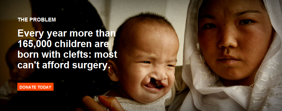 Cleft Palate Excerpt from SmileTrain