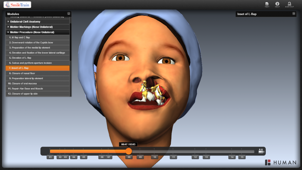 Cleft Surgery Simulation